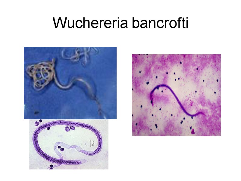 Wuchereria bancrofti